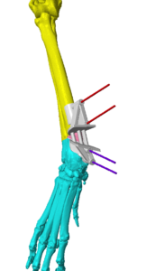 Planning 3D Reconstruction of Kringles Limb