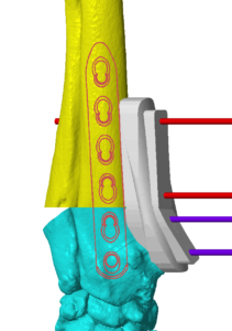 3D Planning of Possible Bone Plate Positioning