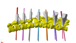 3D-Printed Model Used in Surgery