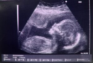 ultrasound image