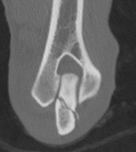Pre-op CT showing Teddy fracture.