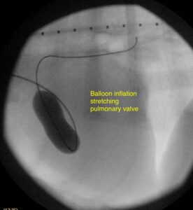 Balloon inflation stretching pulmonary valve