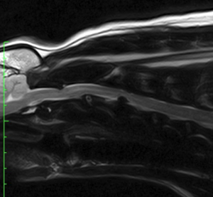Sagittal MRI of the neck showing a C3-C4 intervertebral disc extrusion causing marked spinal cord compression
