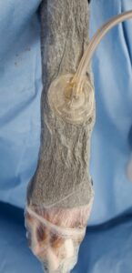 Post-op image with Negative Pressure Wound Therapy Device (NPWT)