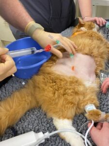 Removal of instilled fluid from abdomen