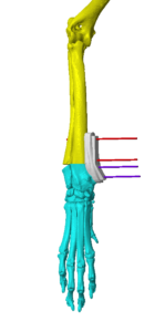 Planning 3D Reconstruction of Kringles Limb