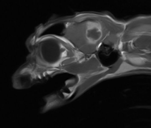 Scan Showing The Abscess in Thea’s Brain