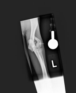 X-rays Showing The Damage to Alfie’s Humerus