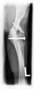 Post Operative X-Ray of Humerus