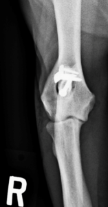 8 week post-op (with screw and plate) showing the healed fracture.
