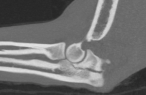 Pre-op CT scan showing fracture.