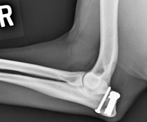 8 week post-op (screw and plate ) showing the healed fracture.