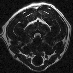 Transverse MRI of the neck showing a C3-C4 intervertebral disc extrusion causing marked midline spinal cord compression